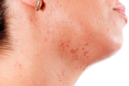 Acne vrouw kaaklijn.jpg