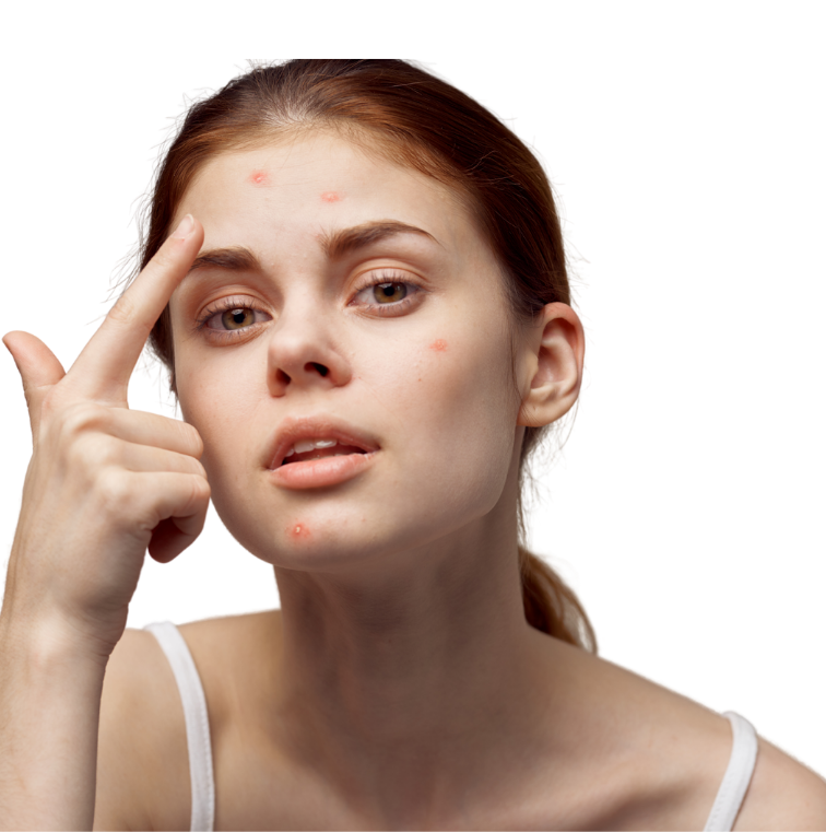 Acne behandeling lasarel