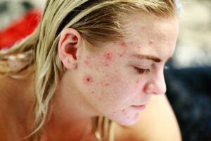 Healthy skin program beautyfarm lasarel